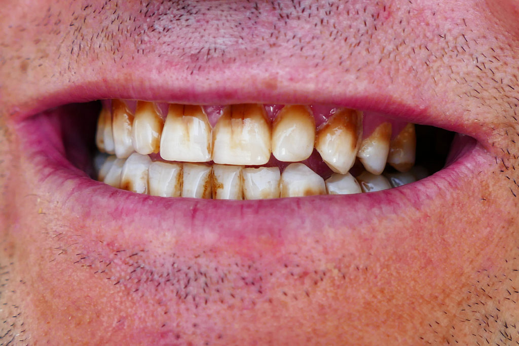what-vaping-does-to-your-teeth-smile-essentials